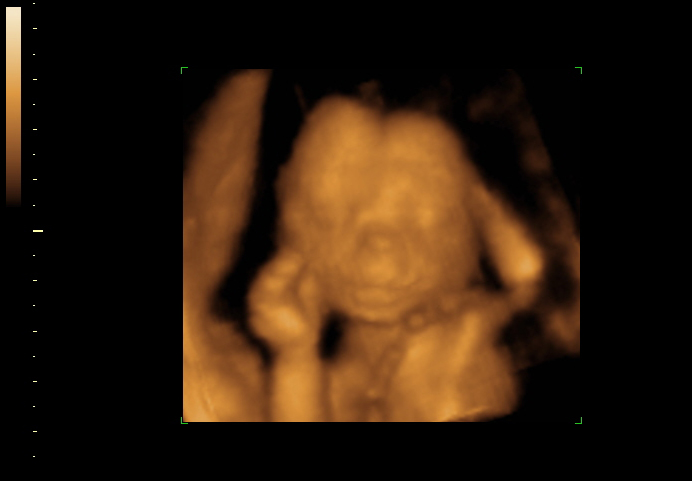 3D ultrasound image at 18 weeks
